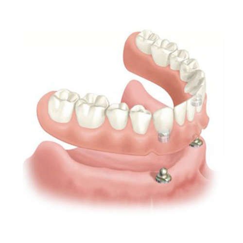 Prothèse dentaire sur implants supérieure et ou inférieure