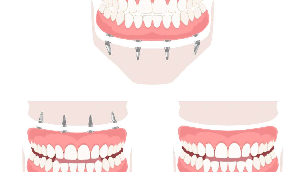 Prothèse complète, partielle ou implants dentaires : quelle solution choisir?